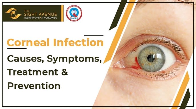 Corneal Infection – Causes, Symptoms, Treatment & Prevention