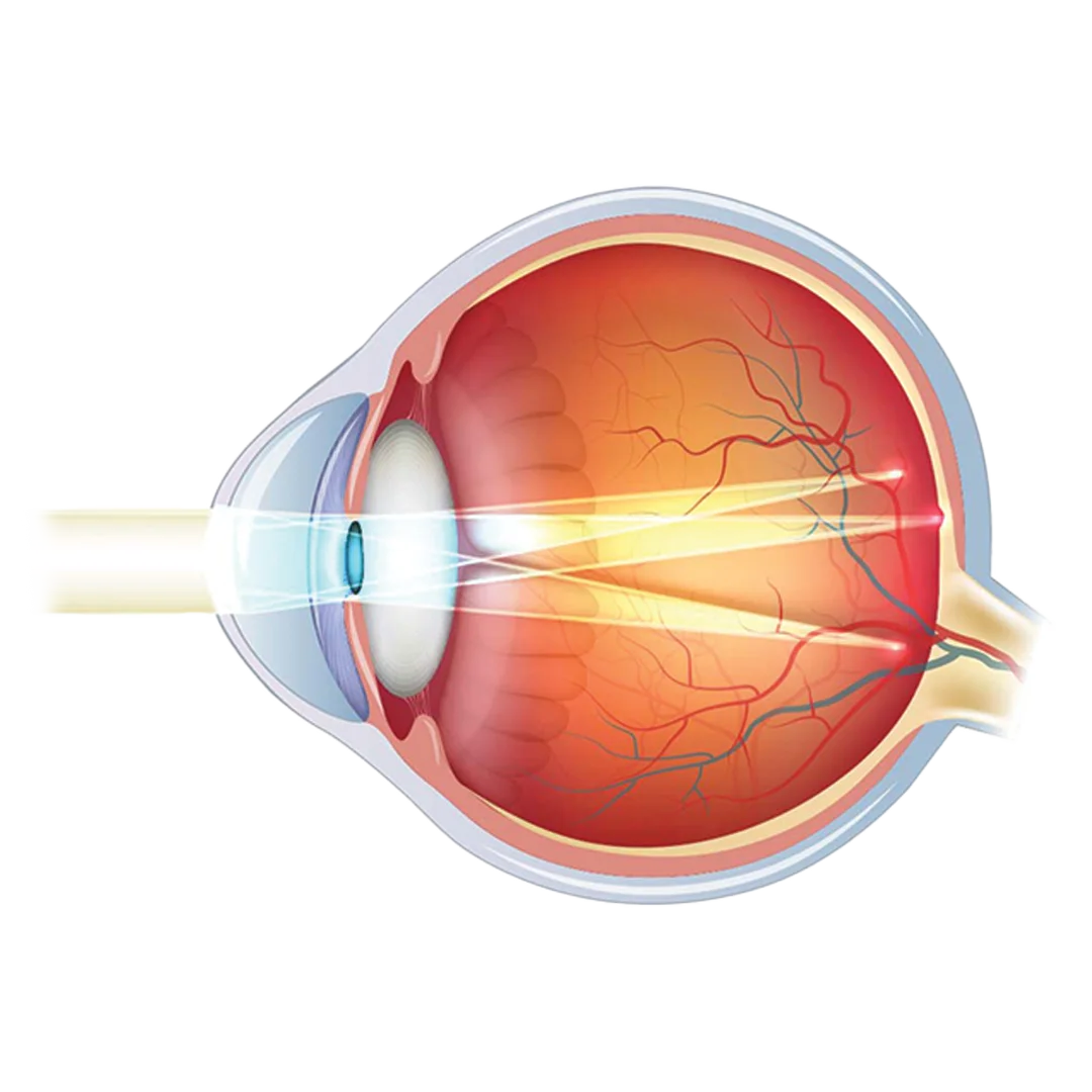Astigmatism eye illustration