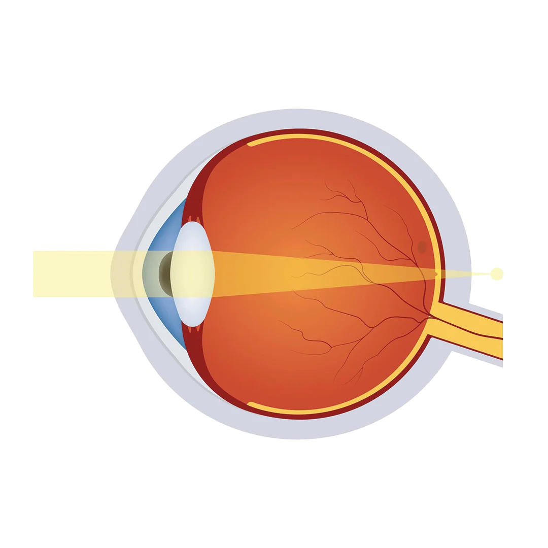 Hyperopia eye illustration