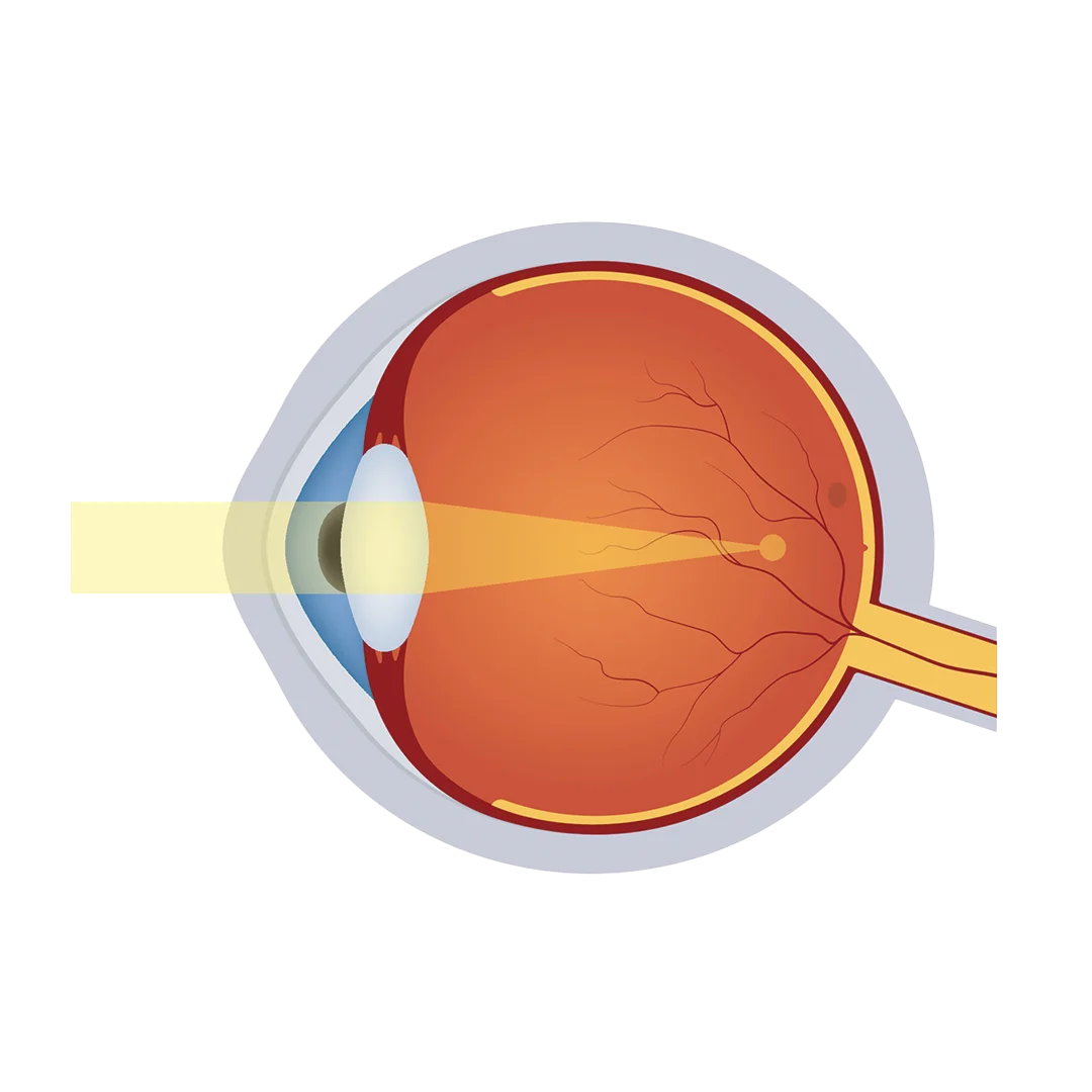 Myopia eye illustration