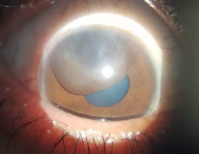 Retina 1