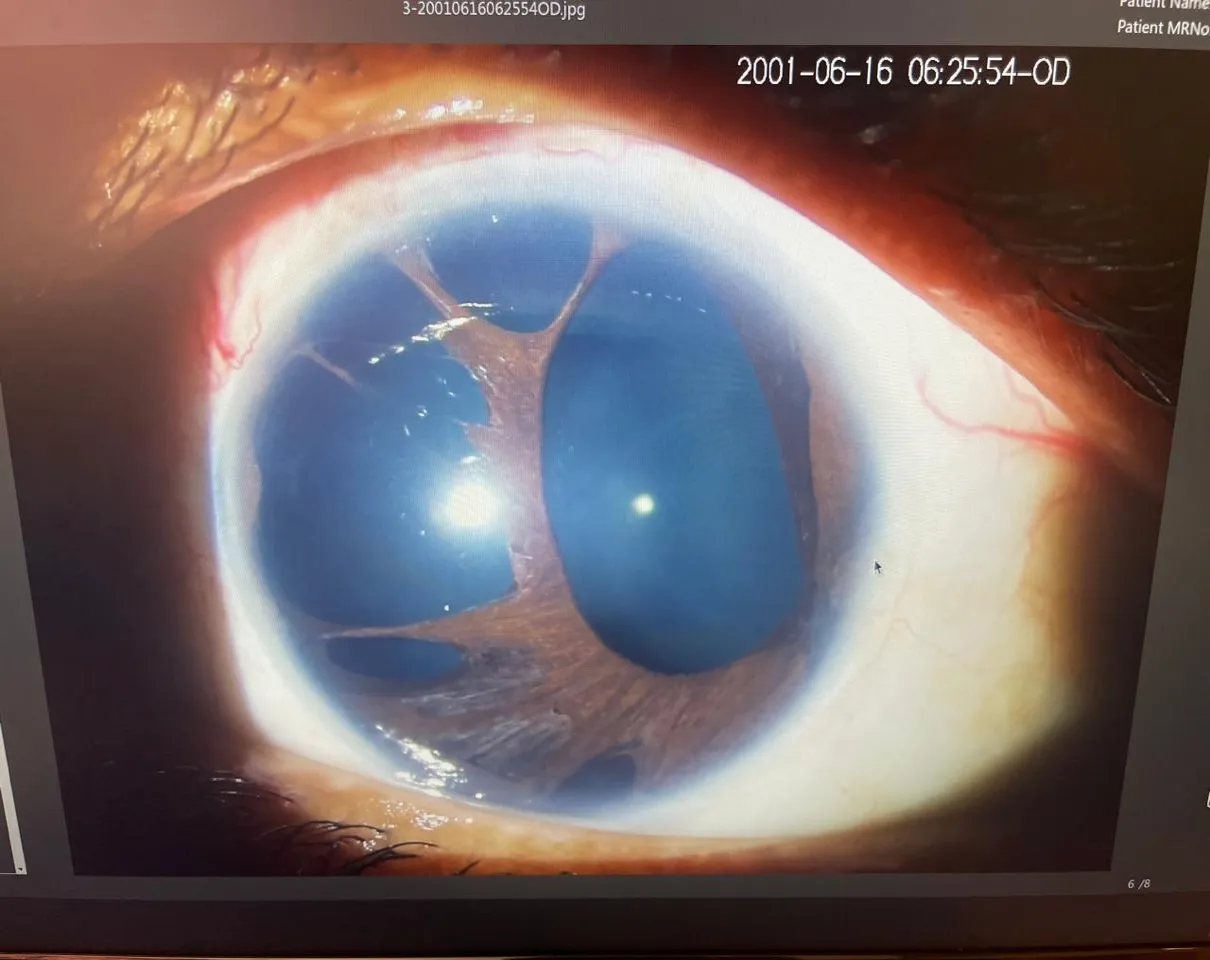 Retina 3