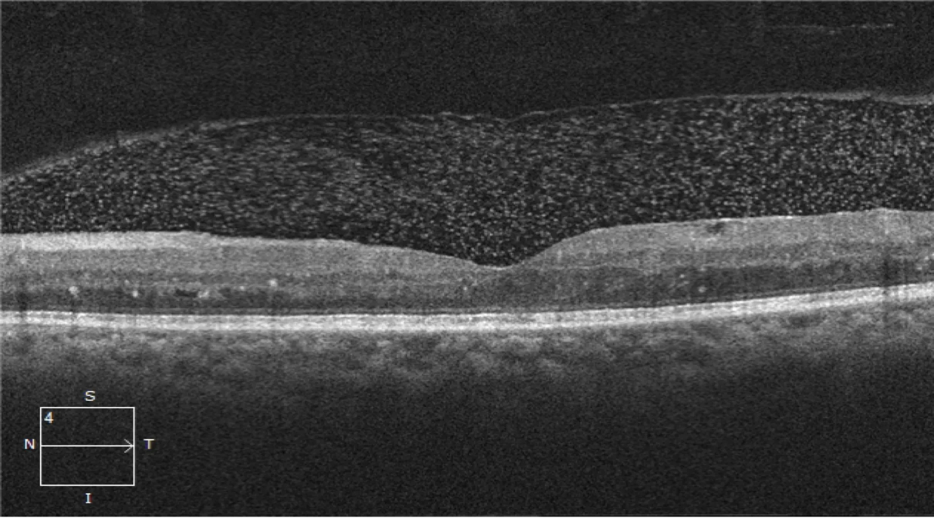Retina 1