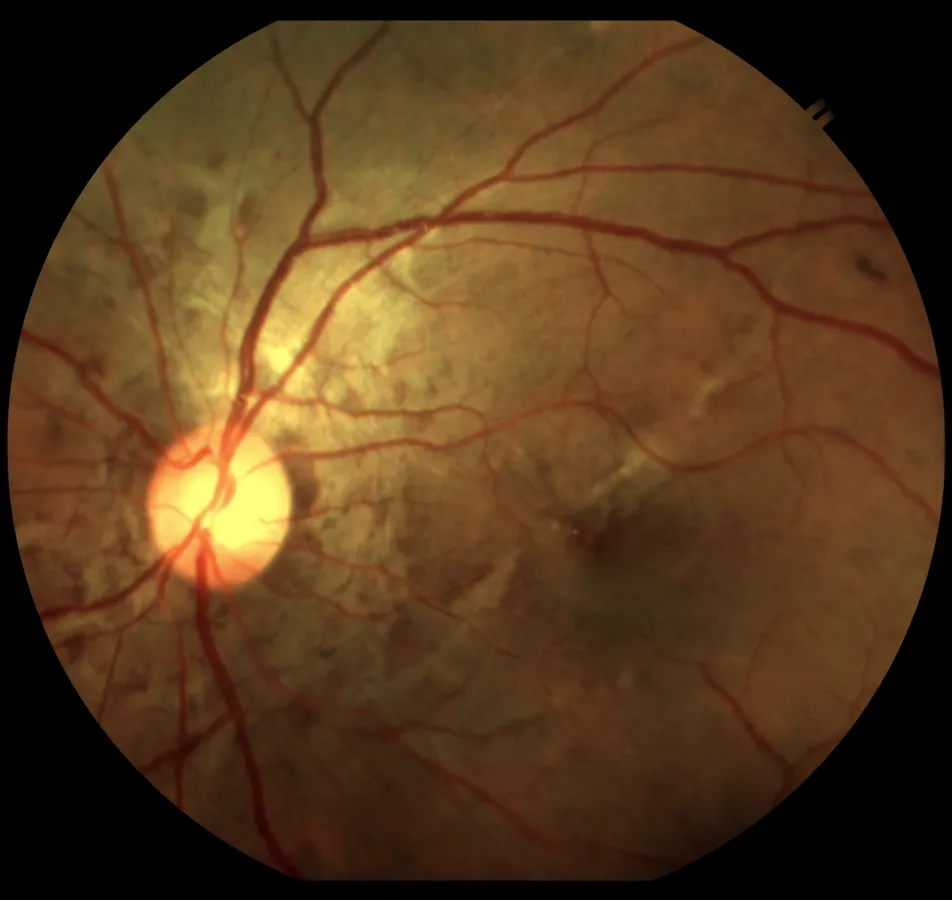 Retina 3