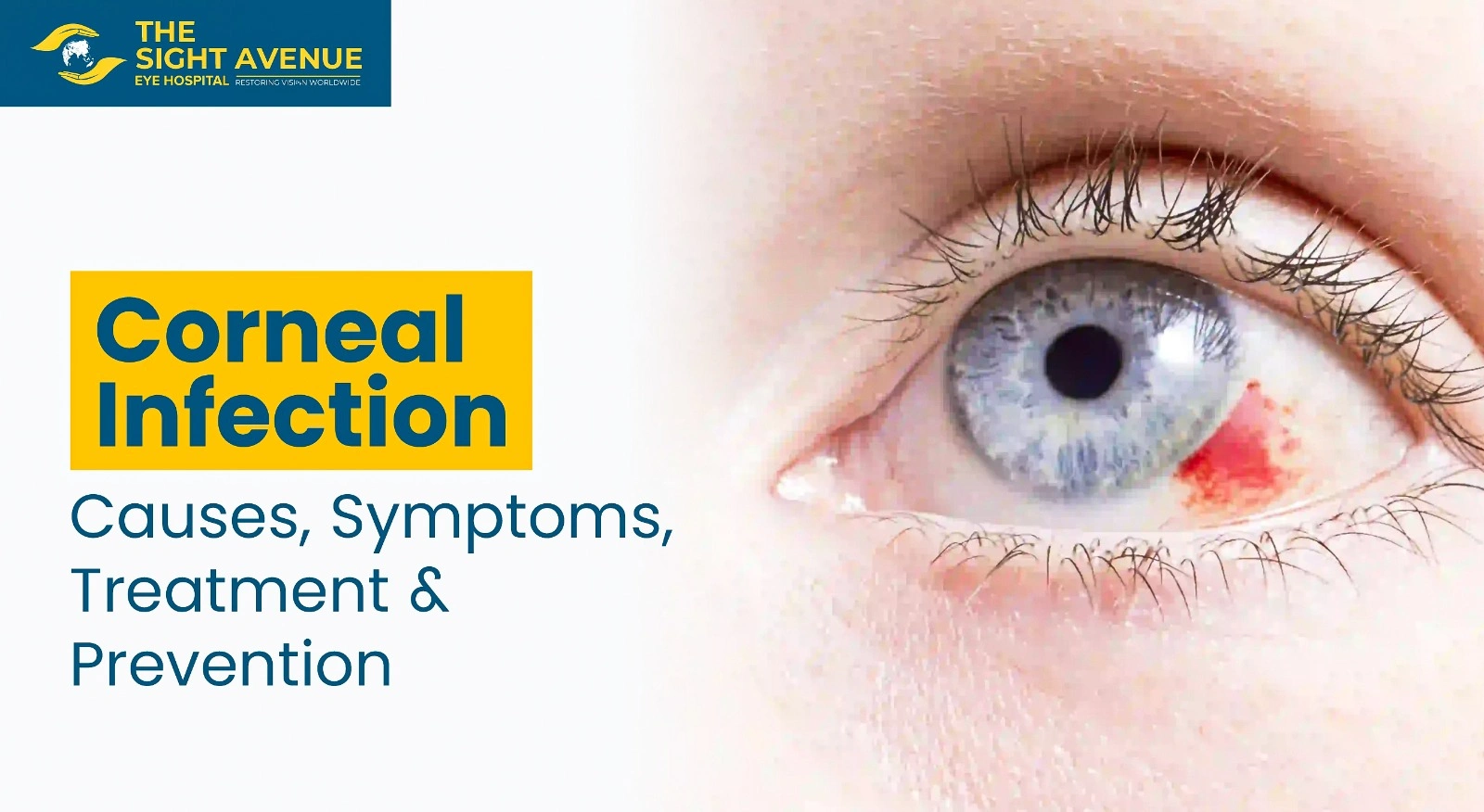 Corneal Infection – Causes, Symptoms, Treatment & Prevention