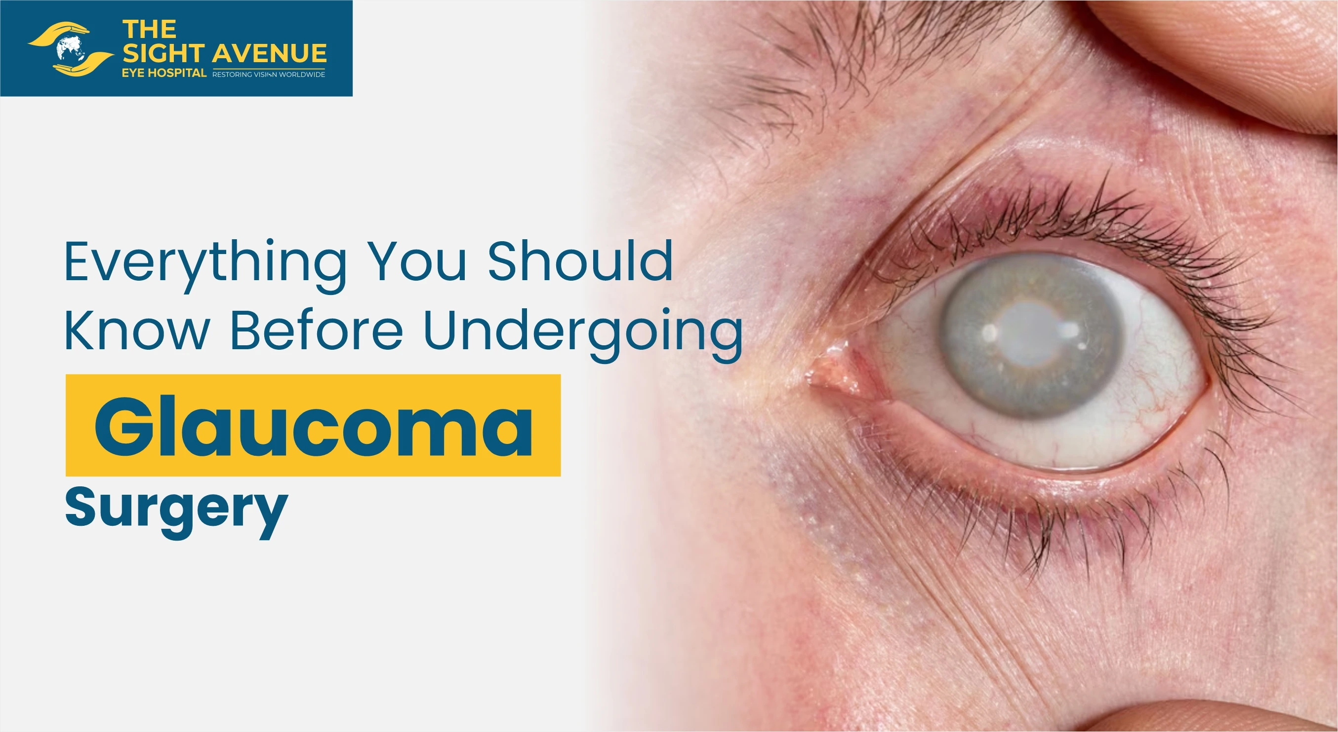 Everything You Should Know Before Undergoing Glaucoma Surgery