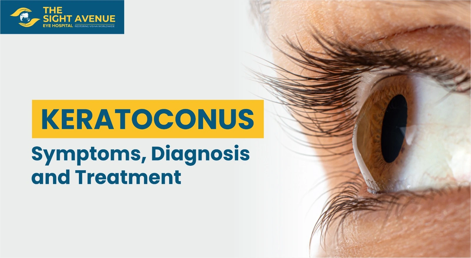 Keratoconus: Symptoms, Diagnosis and Treatment