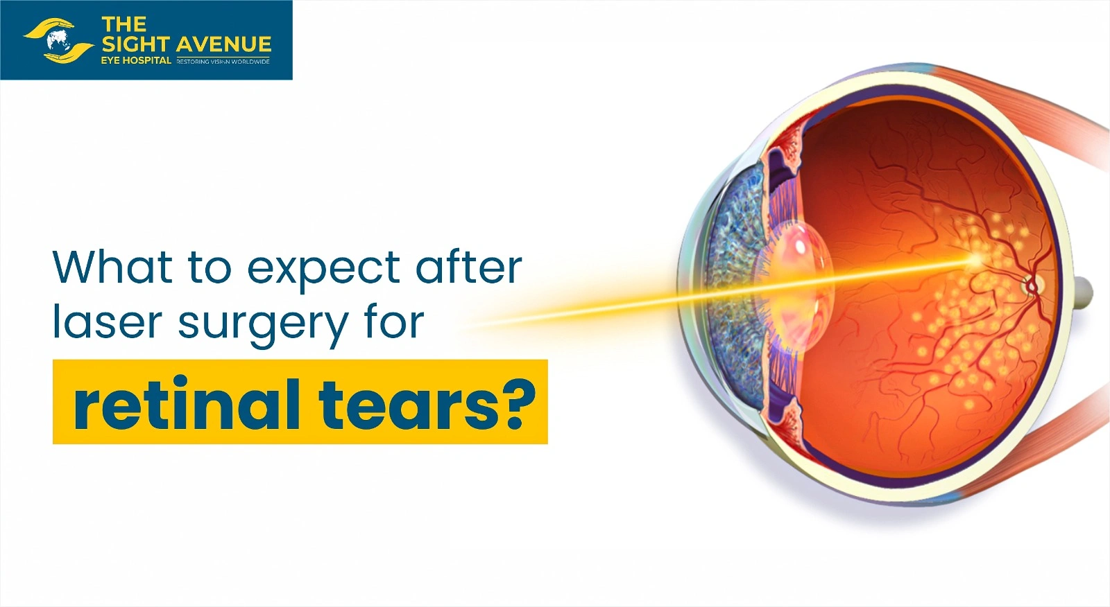 What to expect after laser surgery for retinal tears?